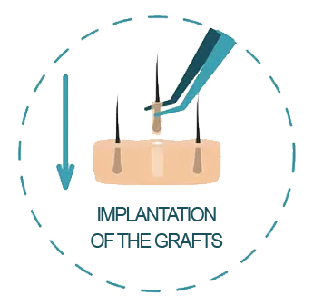 implantation of the grafts