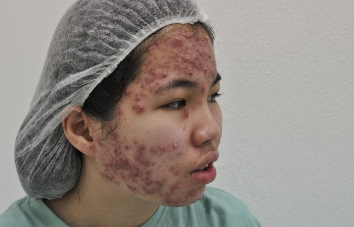Severe face acnes diagnosis before treatment at O2 Klinik