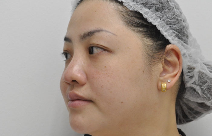 After pigmentation laser treatment at O2 Klinik