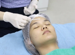 Chemical peels for mild and moderate acnes at O2 Klinik