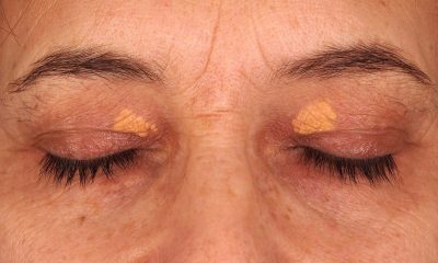 reduce cholesterol in eyelid with xanthelasma laser treatment at O2 Klinik