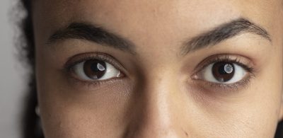 reduce dark circles under eyes with hyaluronic acid fillers at O2 Klinik