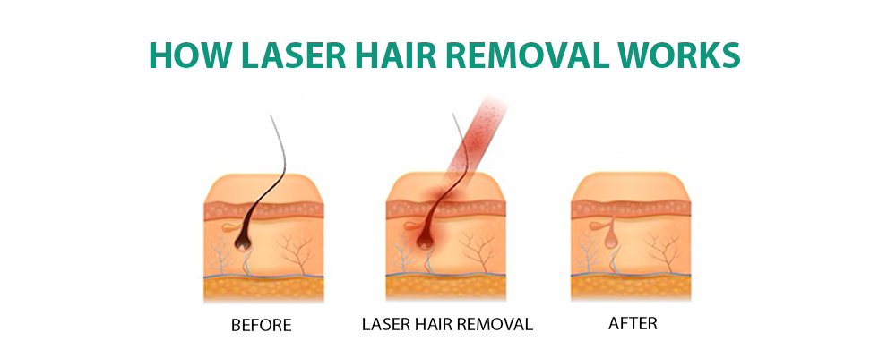 Laser hair removal targeting hair root for more permanent results