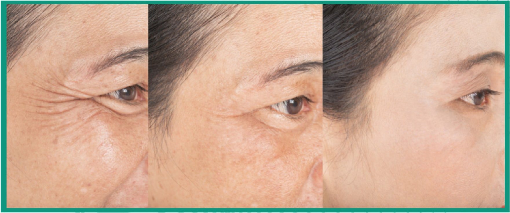 Reduced wrinkles as botox treatment's results in aesthetic clinic