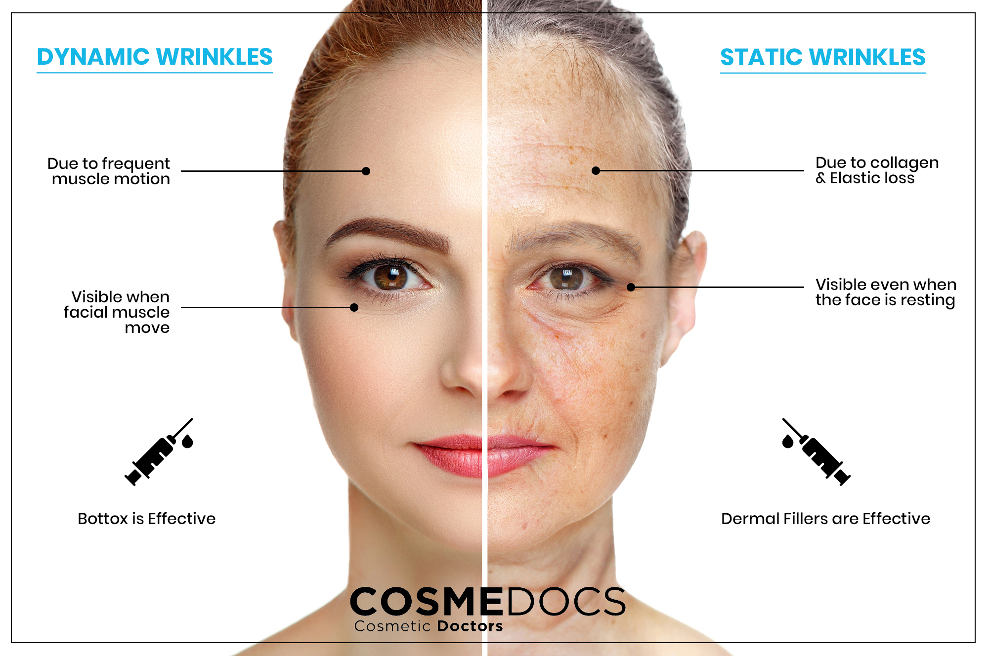Difference between static wrinkles vs dynamic wrinkles in face