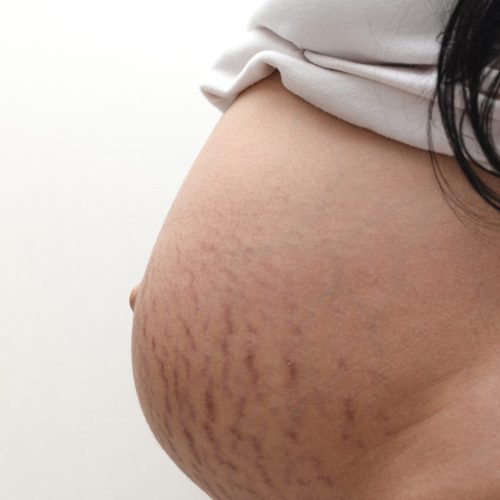 stretch marks on pregnant belly, skin care concept